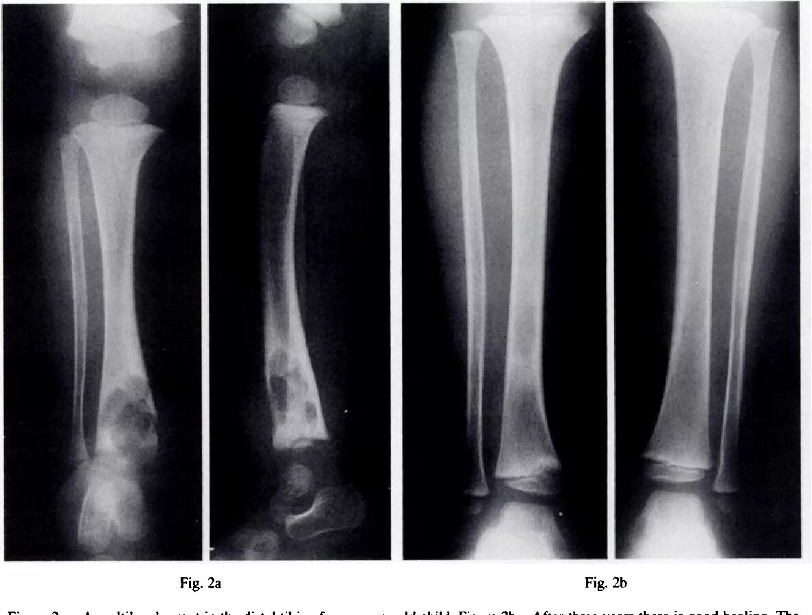 Остеомиелит трубчатых костей рентген. Заболевания скелета (туберкулез, опухоли костей, остеомиелит). Остеомиелит голени рентген. Остеомиелит костно суставной туберкулез.