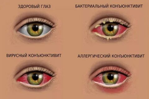Коньюктивит у ребенка передается
