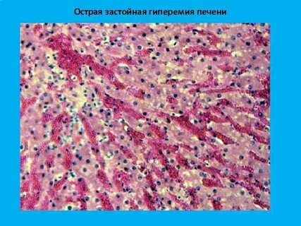 Застой селезенки