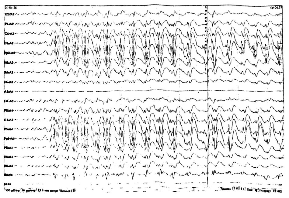 Биоэлектрическая активность диффузного характера. Энцефалограмма. Биоэлектрическая активность мозга. Выраженные диффузные изменения БЭА головного мозга. Диффузное поражение на ЭЭГ.
