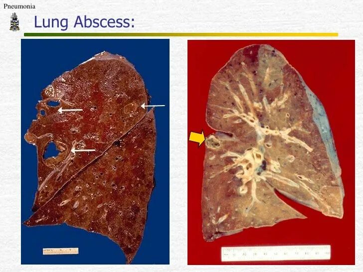 Гнойные абсцессы легких. Острый абсцесс легкого макропрепарат. Абсцесс легкого макропрепарат. Прорыв абсцесса легкого.