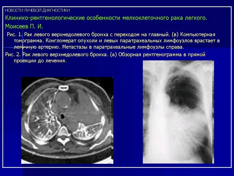 Рентгенодиагностика онкологии. Клинико-рентгенологические особенности опухолей. Лучевая диагностика. Диагностикарака лёгкого. Лечение мелкоклеточного рака