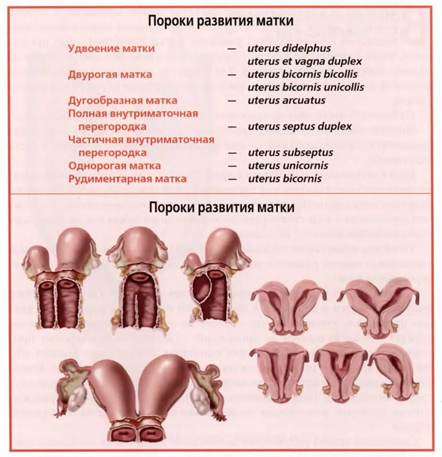 Врожденные пороки развития матки. Аномалии развития матки классификация. Формы пороков развития матки. Пороки развития шейки матки.