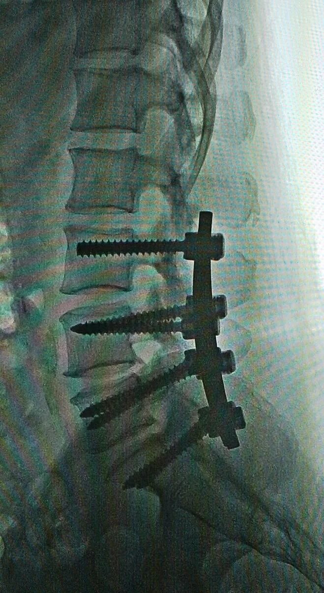 Остеохондроз поясничного отдела l5 s1. Ретролистез l5 операция. Имплант l2 l3 позвонка. Вертебропластика с7 позвонка.