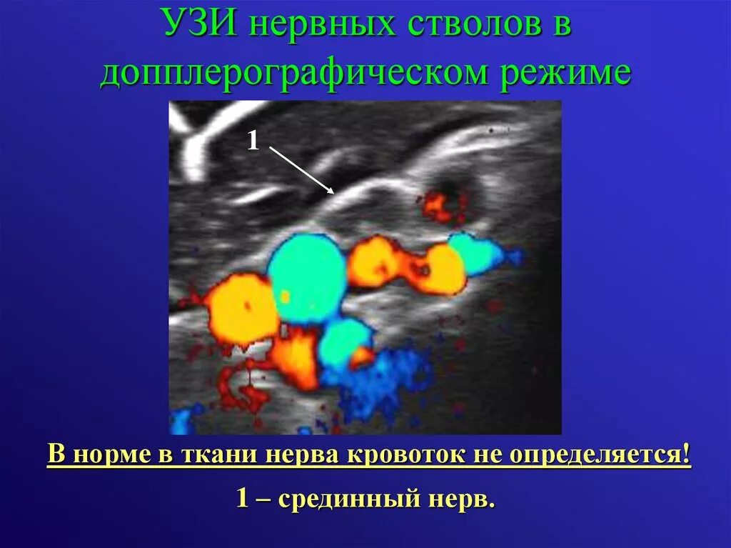 Кровоток не определяется
