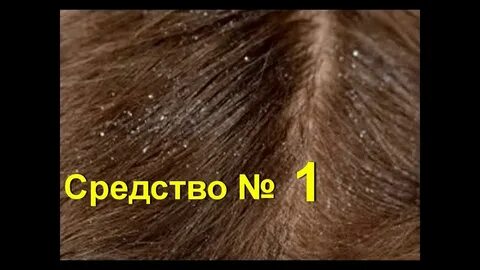 Как быстрее избавиться от перхоти