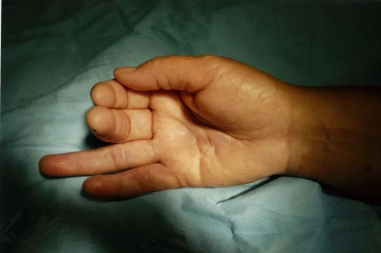Суставы пальцев сильно. Ревматоидный артрит кистей пальцев рук. Искривление пальцев рук.