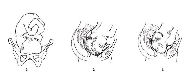 Головное предлежание плода задний вид. Затылочное положение плода. Биомеханизм родов при затылочном предлежании. Положение ребенка в родах. Путь ребенка во время родов