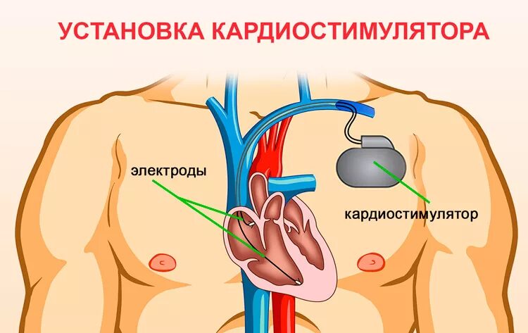 Кардиостимулятор сердца как проходит операция. Электрокардиостимулятора сердца. установка кардиостимулятора. установленный кардиостимулятор.