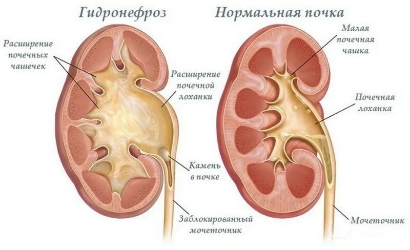 Почечная лоханка рисунок