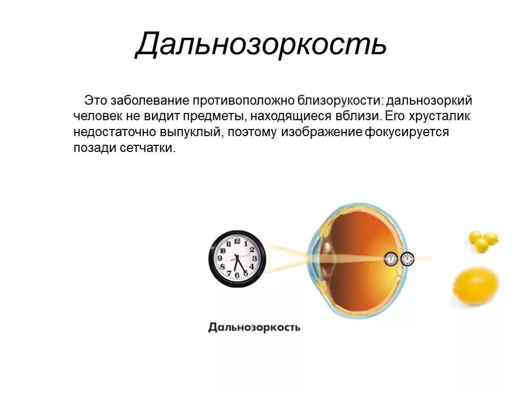 Гиперметропический астигматизм у детей. Дальнозоркость и астигматизм. Заболевание дальнозоркость. Человек с дальнозоркостью. Как видят дальнозоркие люди