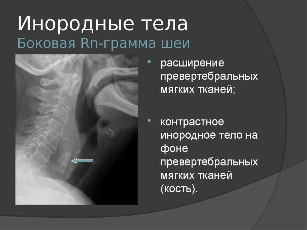 Инородное тело глотки рентген. Инородное тело глотки симптомы. Инородное тело в трахее рентген. Инородное тело по мкб 10 у взрослых