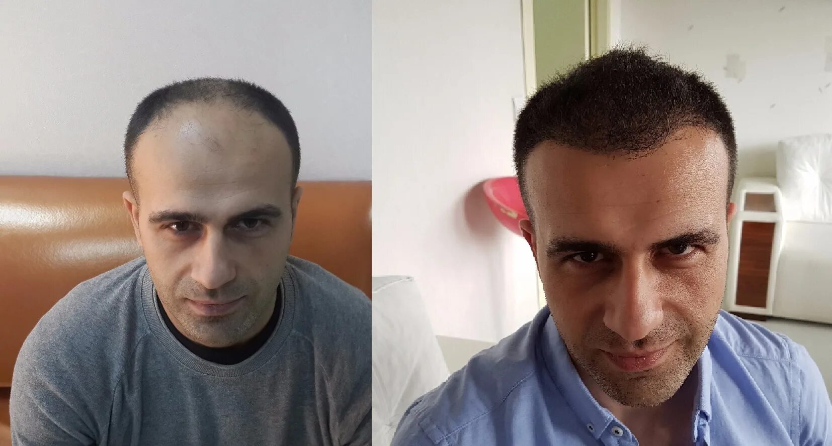 Fehmi Arman FA Hair Transplant Turkey - #3 by nevorisu - Hair Transplant - HairS