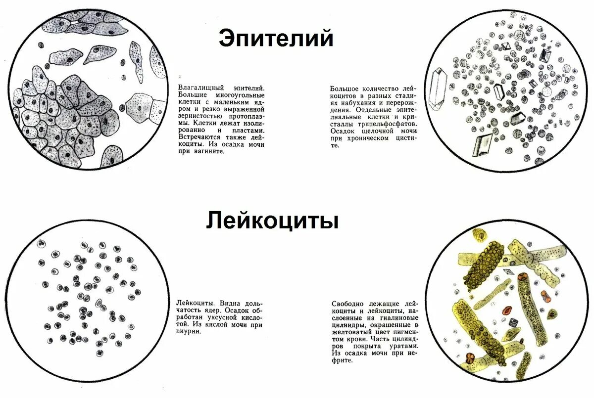 Лейкоциты микроскопия в моче норма. Эритроциты в моче микроскопия. Микроскопия мочи лейкоциты и эритроциты. Микроскопия осадка мочи лейкоциты норма. Эритроциты и лейкоциты в моче у мужчин