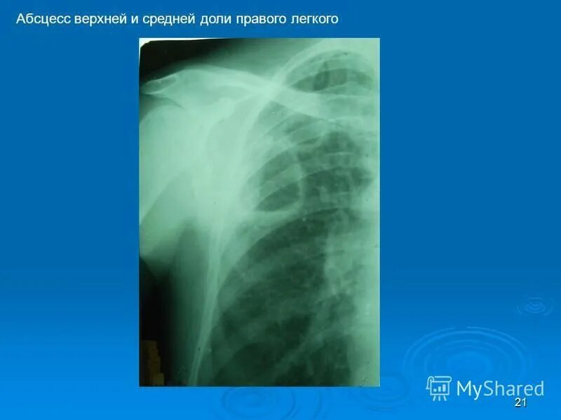 сегментарная пневмония правого легкого. пневмония правосторонняя s4 s5 сегментарная. сегментарная пневмония правого легкого. очаговая сегментарная долевая пневмония. очаговая сегментарная долевая пневмония.