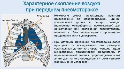 Пневмоторакс это скопление воздуха в