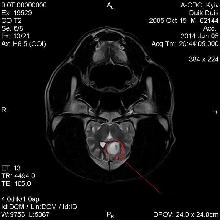 Опухоль мозга у собак. Опухоль головного мозга у собак. Мрт головного могзгас обаки. Опухоль головного мозга у собаки симптомы.