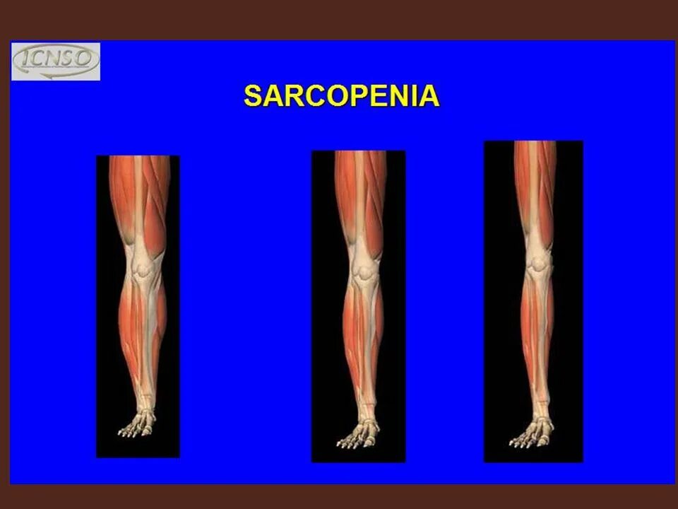 Саркопения это простыми словами. Саркопения. Мышечная саркопения. Старческая саркопения.