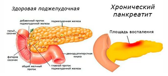 Панкреатит симптомы у мужчин препараты. Здоровая поджелудочная железа. Панкреатит поджелудочной железы. Хронический панкреатит.