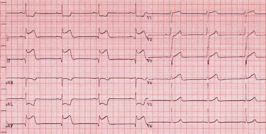 Экг подъем. ЭКГ острый инфаркт миокарда с подъемом St. ОИМ С подъемом St ЭКГ. ЭКГ при инфаркте миокарда с подъемом St. Окс c подъемом сегмента St ЭКГ.