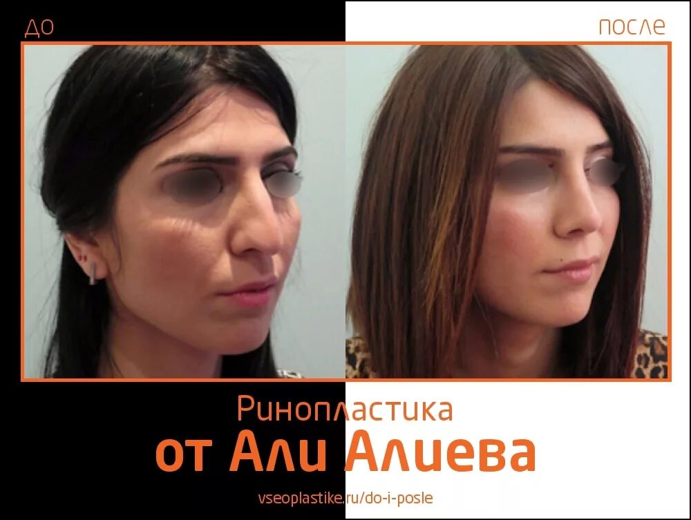 алиев али ринопластика. алиев пластический хирург отзывы. гурьянов кантопластика. алиев пластический хирург отзывы. риносептопластика ярославль.