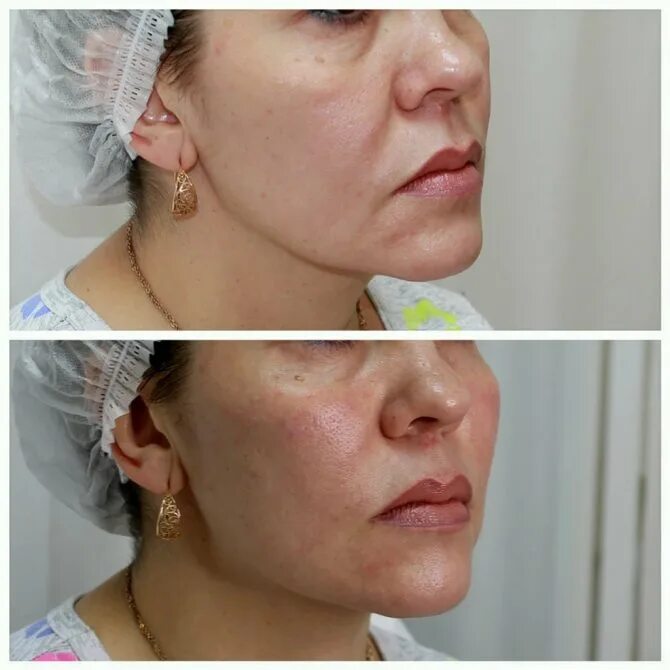 контурная пластика лица. ограничения после филлеров. принцесс волюм скулы. скулы до и после. сеул до и после.