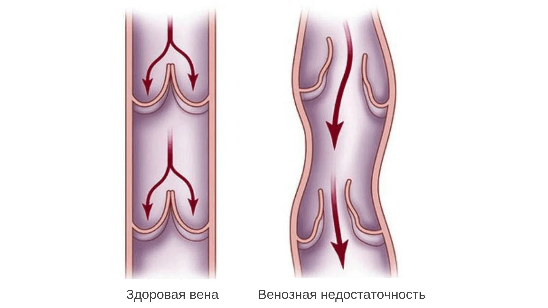 Варикозное расширение вен ХВН 1 степени. Варикозное расширение вен нижних конечностей ХВН. Варикозно расширенные вены. Тромбоз кровотечение