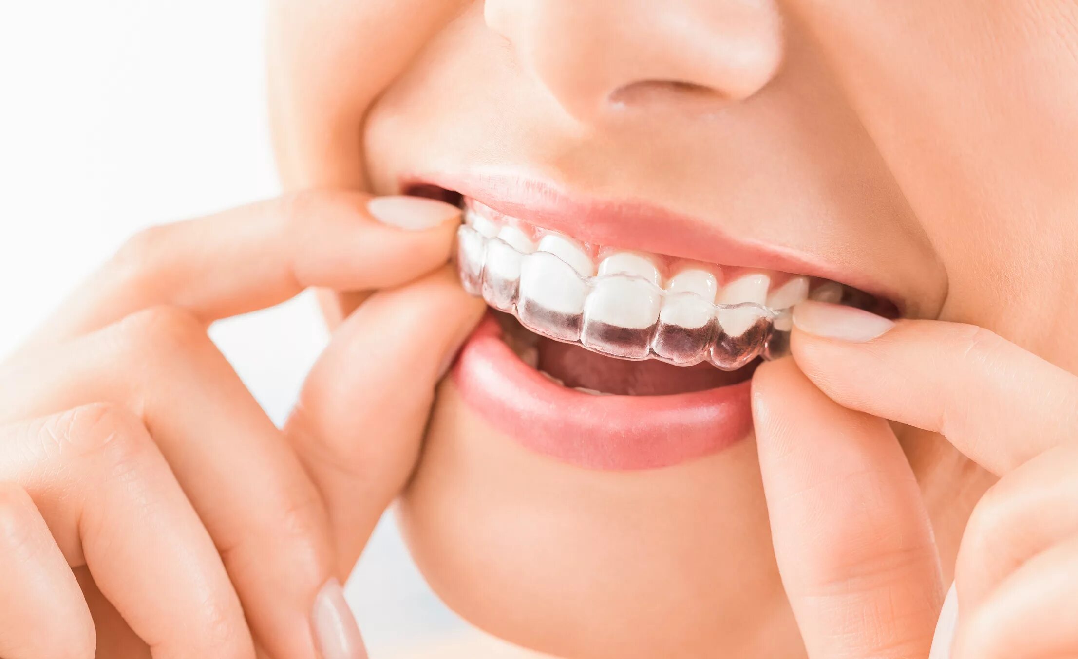 Invisalign. Каппы инвизилайн. элайнеры (каппы) инвизилайн (invisalign). элайнеры invisalign. альтернатива брекетам элайнеры.