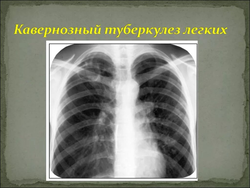 Туберкулез легких. Каверна туберкулез рентген. Кавернозный туберкулез рентген. Каверна при туберкулезе на рентгене. Кавернозная форма туберкулеза легких рентген.