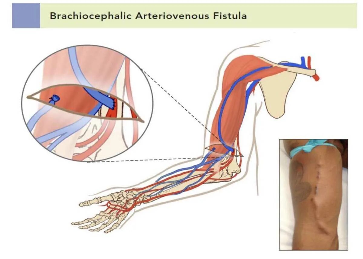 Фистула. Артериовенозная фистула для гемодиализа.