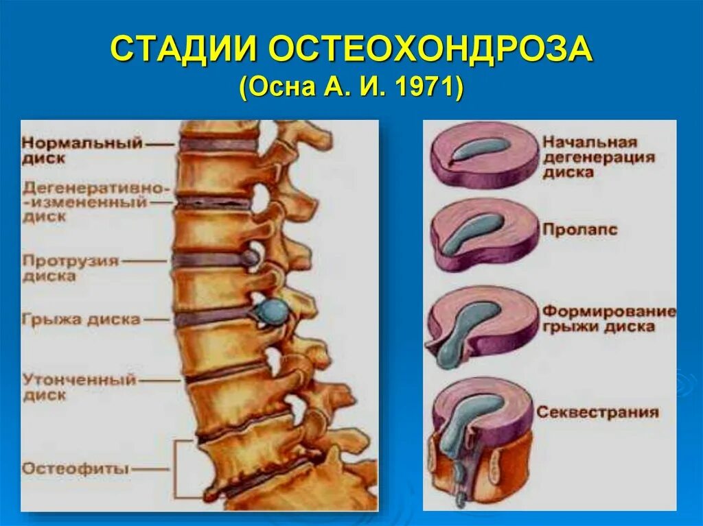 Остеохондроз какие степени