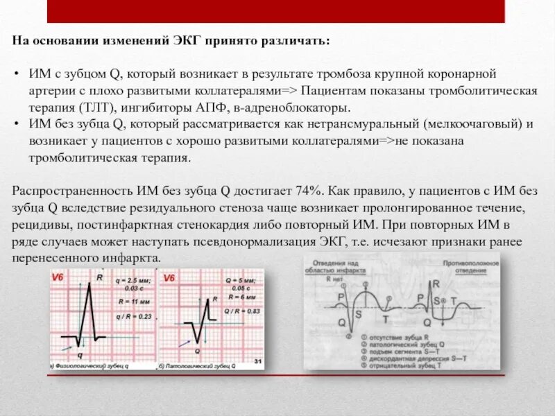 Изменение зубца q. Изменения на ЭКГ. Левограмма на ЭКГ. Дискордантные изменения на ЭКГ. Изменения зубца q на ЭКГ.