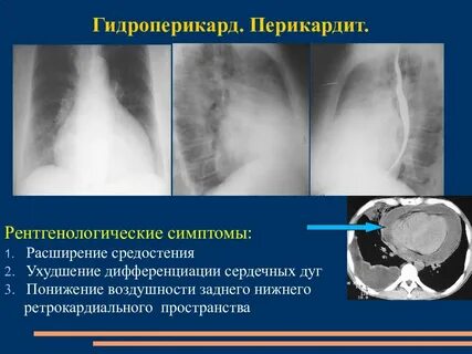Перикардит симптомы