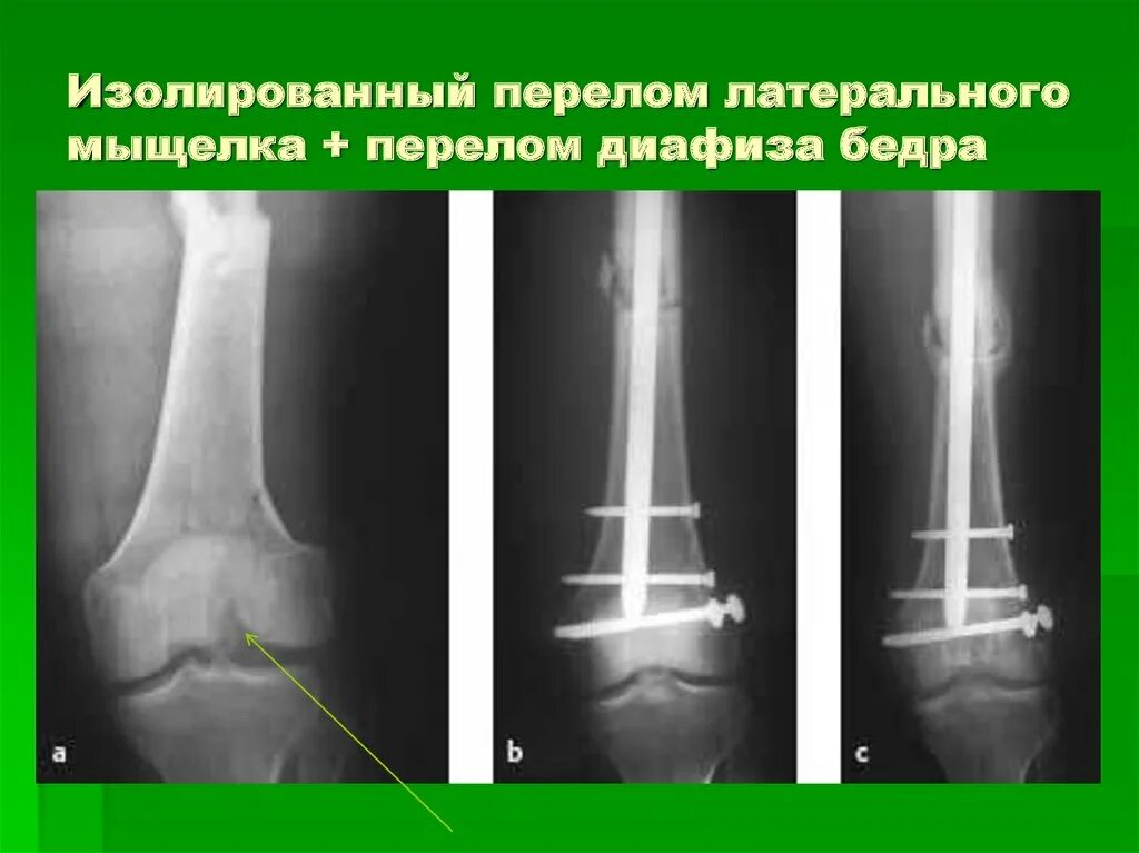 Мыщелки колена. Перелом мыщелков бедренной кости рентген. Перелом большеберцовой кости в суставе. Перелом мыщелка большеберцовой кости. Импрессионный перелом большеберцовой кости.