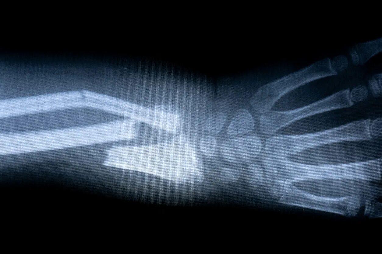 A fracture is a broken bone
