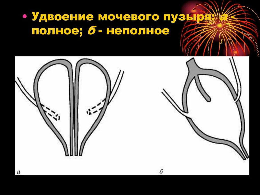 Аномалия мочевого. Аномалии развития мочевого пузыря. Агенезия мочевого пузыря. Удвоение мочевого пузыря рентген. Полное и неполное удвоение мочевого пузыря.