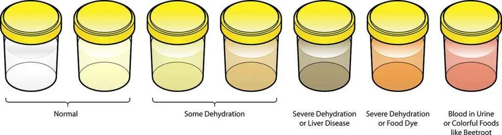 Светло мутная моча. Нормальный цвет мочи. Цвет и прозрачность мочи. Прозрачный цвет мочи. Прозрачная желтая моча.