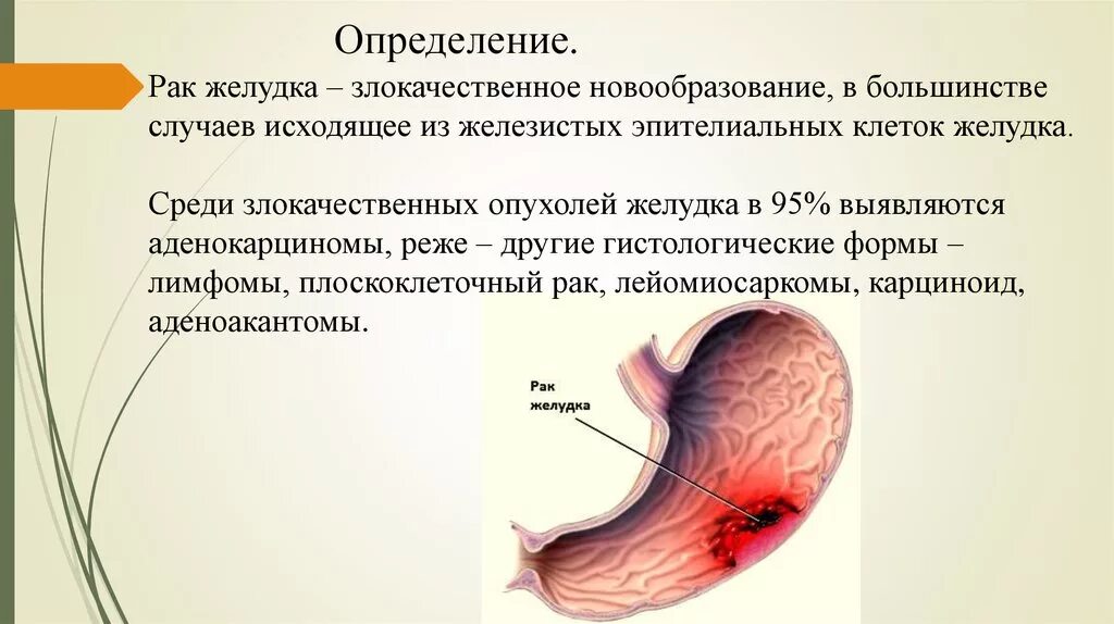 Злокачественное новообразование желудка. Злокачественная опухоль желудка. Раковая опухоль желудка. Злокачественное образование желудка. Эпителиальное образование желудка что это