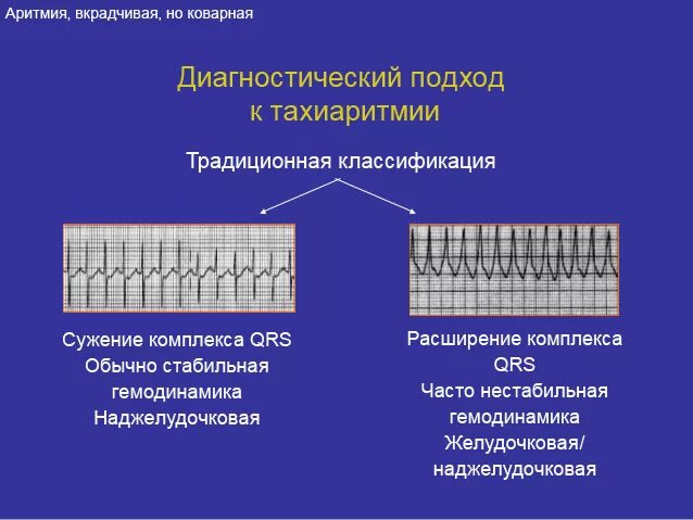 Мкб пароксизм желудочковая тахикардия. Пароксизм тахиаритмии. Клинические проявления при пароксизмальной тахикардии. Синусовая пароксизмальная тахикардия на экг. Желудочковая тахикардия на экг признаки.