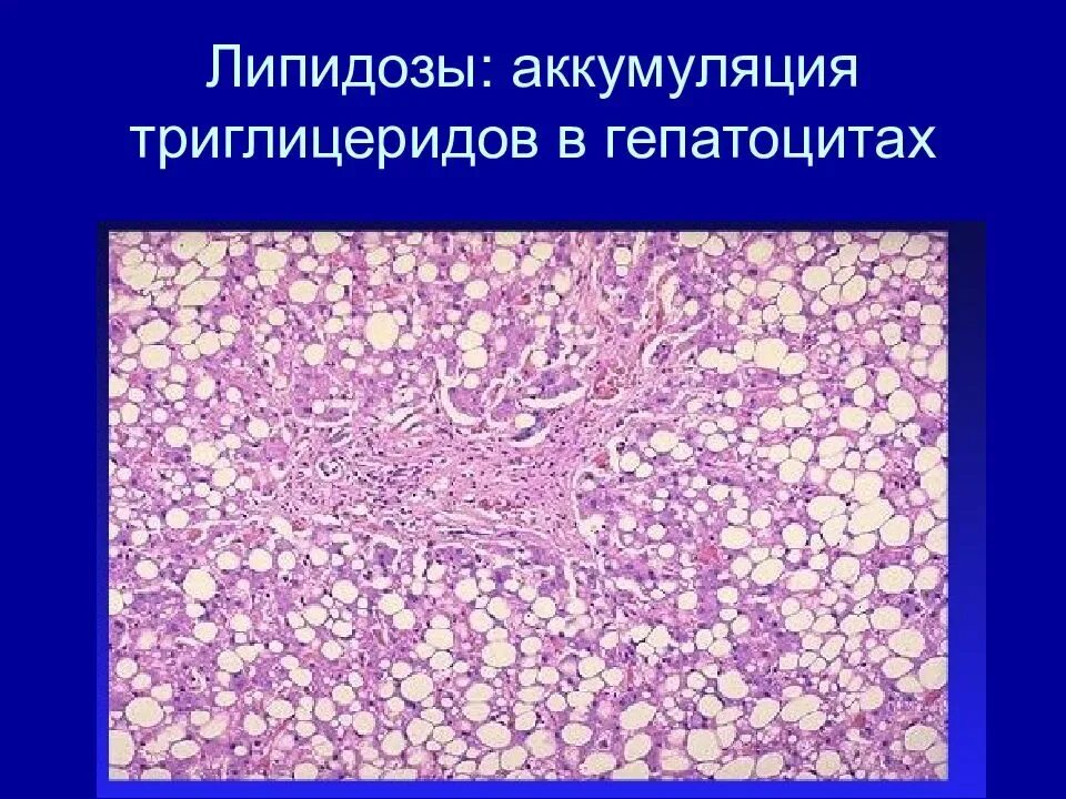 Липидоз печени. Липидоз печени