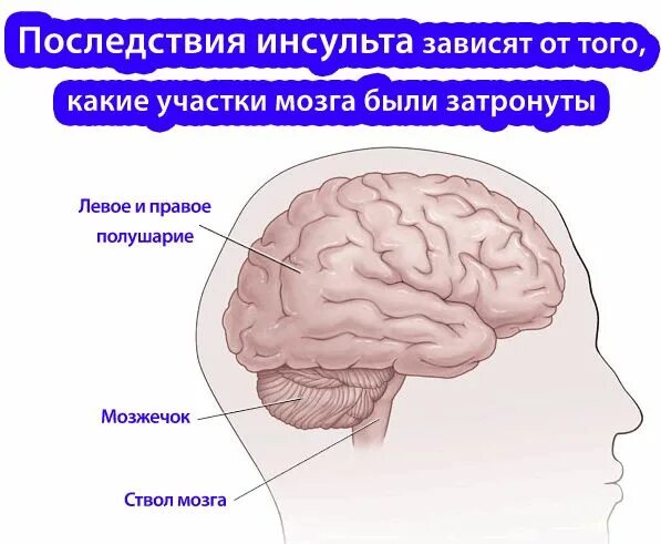 Осложнения после инсульта