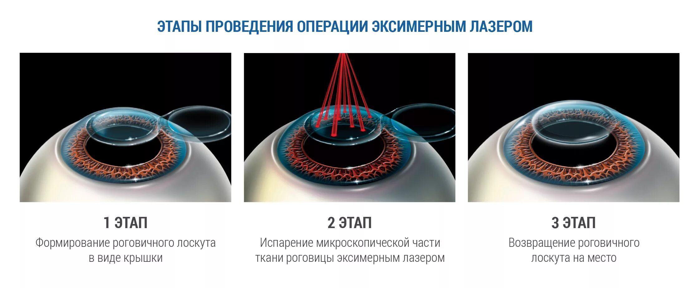 Лазерная коррекция зрения спустя много лет отзывы. Коррекция зрения методом ласик. Эксимер-лазерная коррекция астигматизма. Эксимерлазерная коррекция зрения. Лазерная коррекция зрения операция.