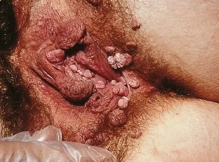 Severe case of genital warts on a. 