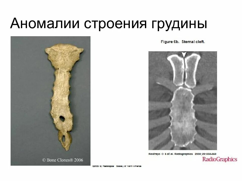 Аномалии строения. Аномалии мечевидного отростка. аномалии мечевидного отростка грудины. патологии мечевидного отростка грудины.