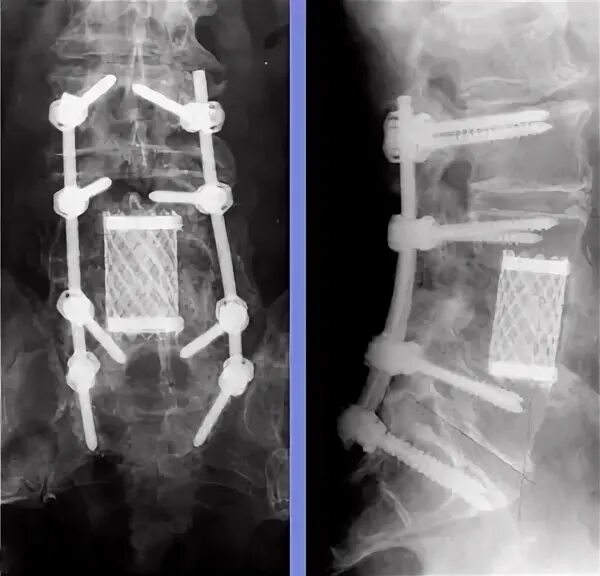 транспедикулярная фиксация th11-l2. передний спондилодез l5. задний спондилодез l5 l6. кт 2 челюсти бухты гайморовых пазух. титановые кт.