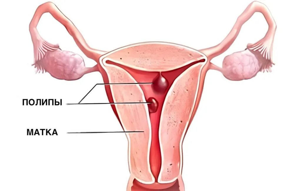 Слизистая стенок матки. Эндометриальный полип. Полипоз эндометрия матки.