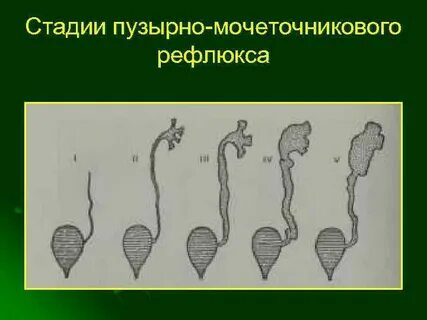 Степени гидронефроза