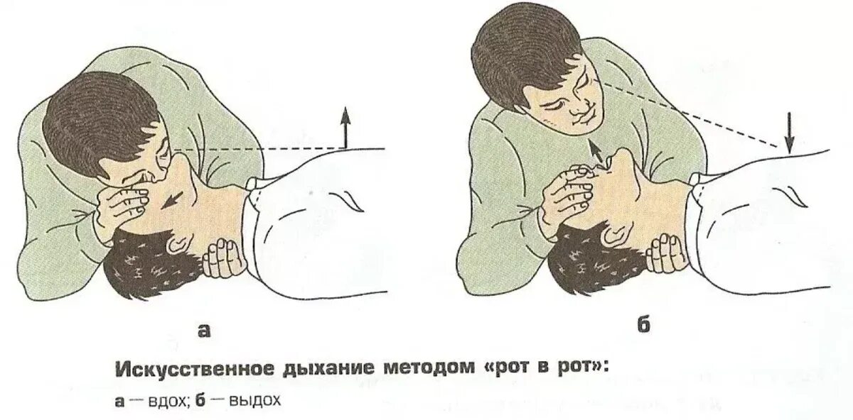 Стеной дыхания. Техника искусственного дыхания рот в нос. искусственная вентиляция лëгких и непрямой массаж сердца. алгоритм искусственного дыхания. схема проведения искусственного дыхания.