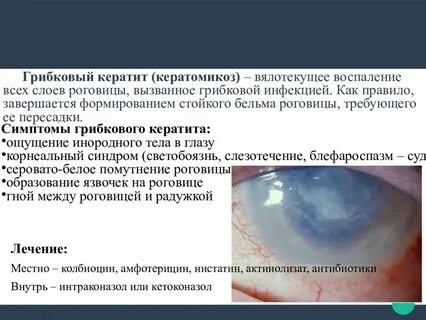 Кератит лечение препараты