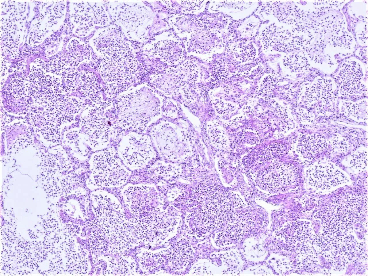 Интерстициальная пневмония гистология. Гистология пневмонии. Геморрагическая пневмония гистология. Стрептококковая пневмония микропрепарат. Патологическая анатомия пневмоцистной пневмонии.